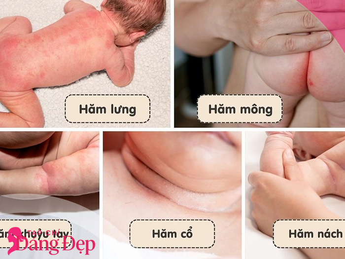 Cách trị hăm tã cho bé hiệu quả nhanh bằng nguyên liệu tự nhiên