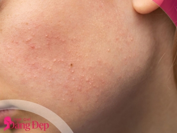 Cách trị mụn ẩn tại nhà bằng nguyên liệu thiên nhiên - Tạp chí Dáng Đẹp