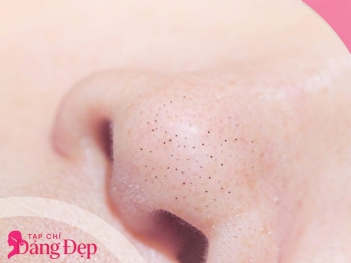 Cách trị mụn đầu đen hiệu quả không cần nặn đau rát - Tạp chí Dáng Đẹp