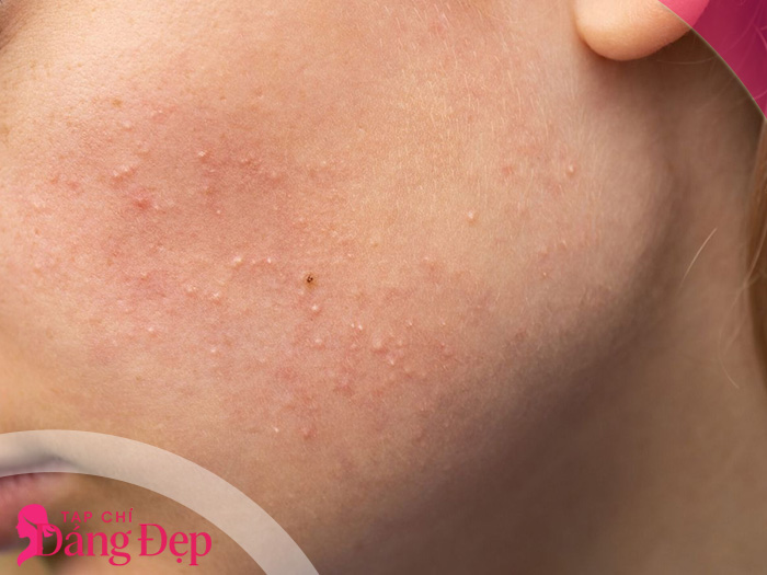 cách trị mụn ẩn tại nhà